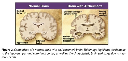 Alzheimer;s and dementia planning, medicaid planning, medicaid plus